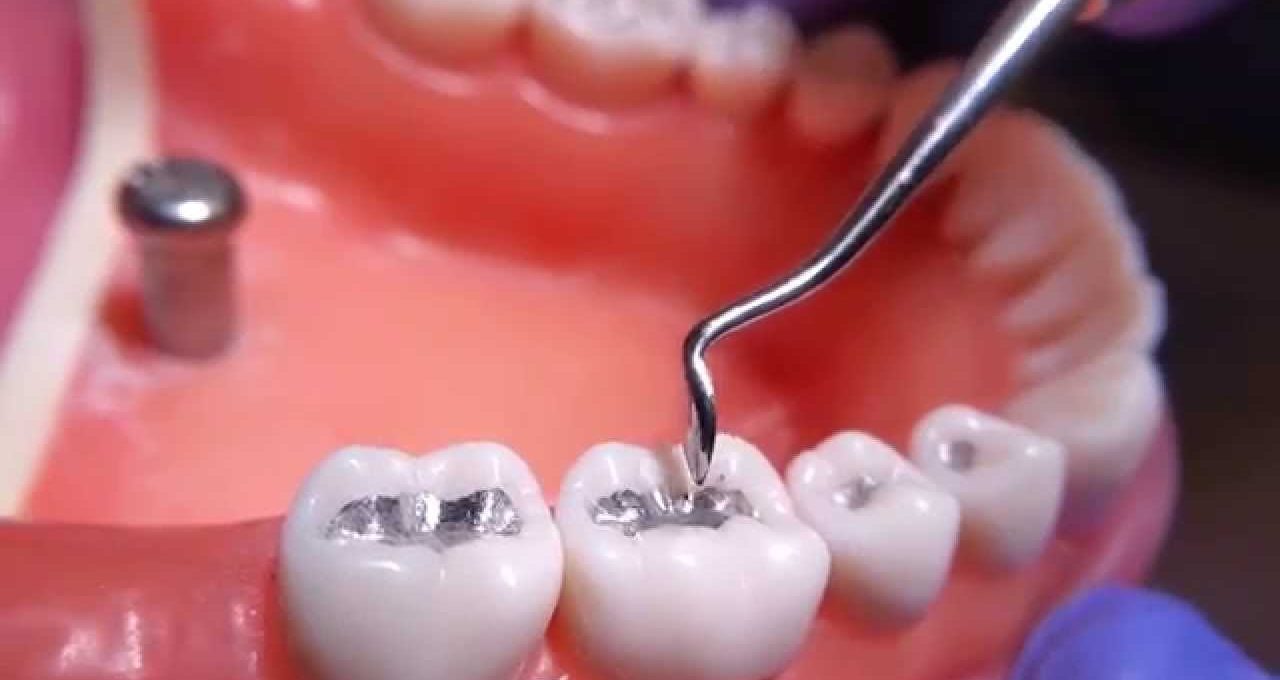 All you need to know about Dental Amalgam