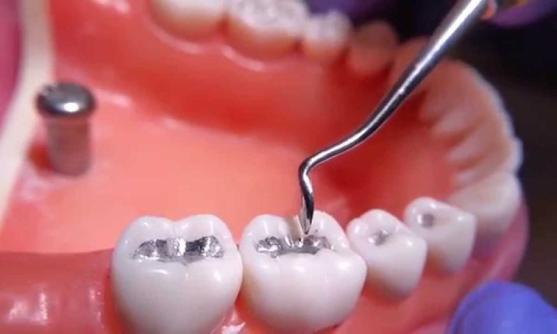 All you need to know about Dental Amalgam